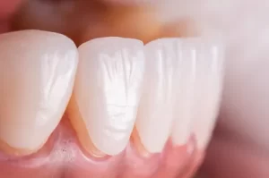 陶瓷貼片